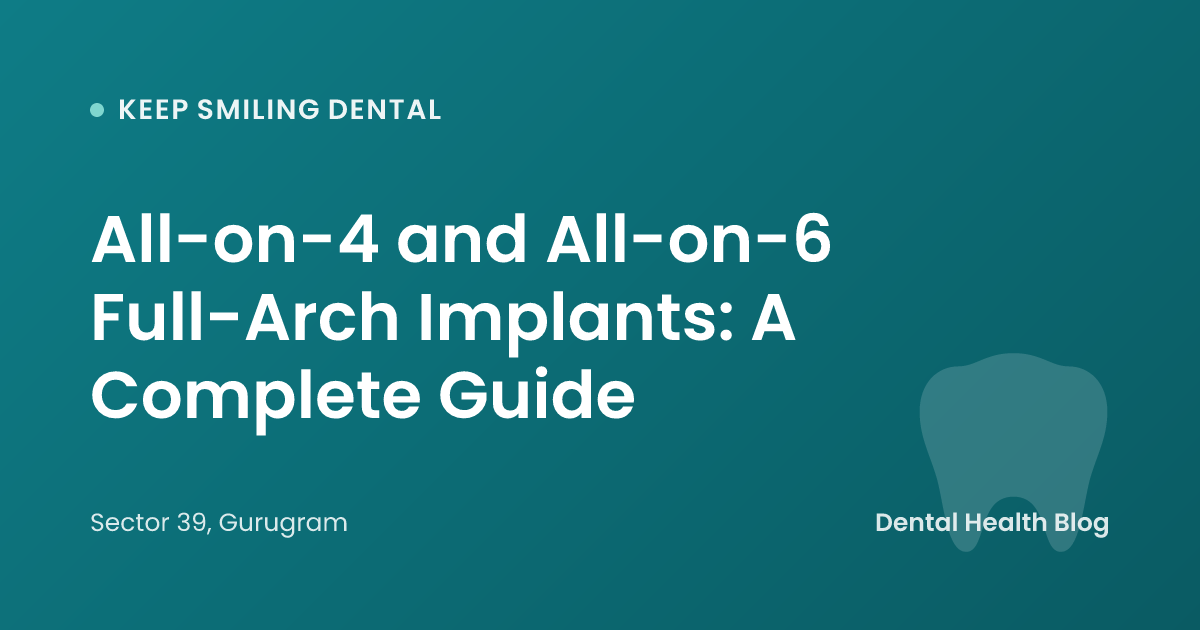All-on-4 and All-on-6 Full-Arch Implants: A Complete Guide